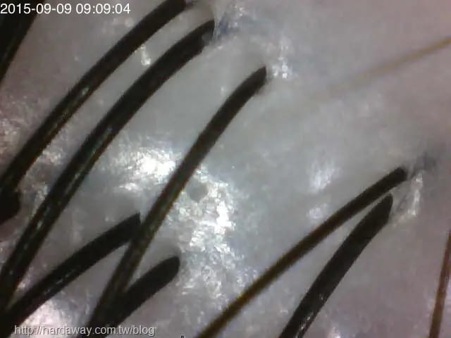 头皮检测仪图像标注：毛囊根部硬化皮脂与死皮积聚——温哥华 Salon Era Zoey Wu 头皮护理科普