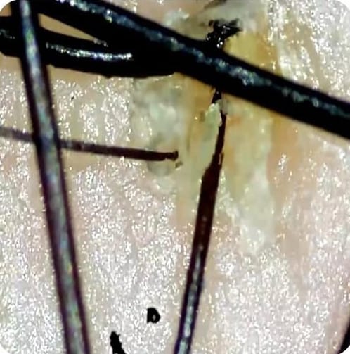 头皮毛囊根部皮脂与死皮堆积近距离特写——温哥华 Salon Era 发型师 Zoey Wu 最常见到的头皮问题