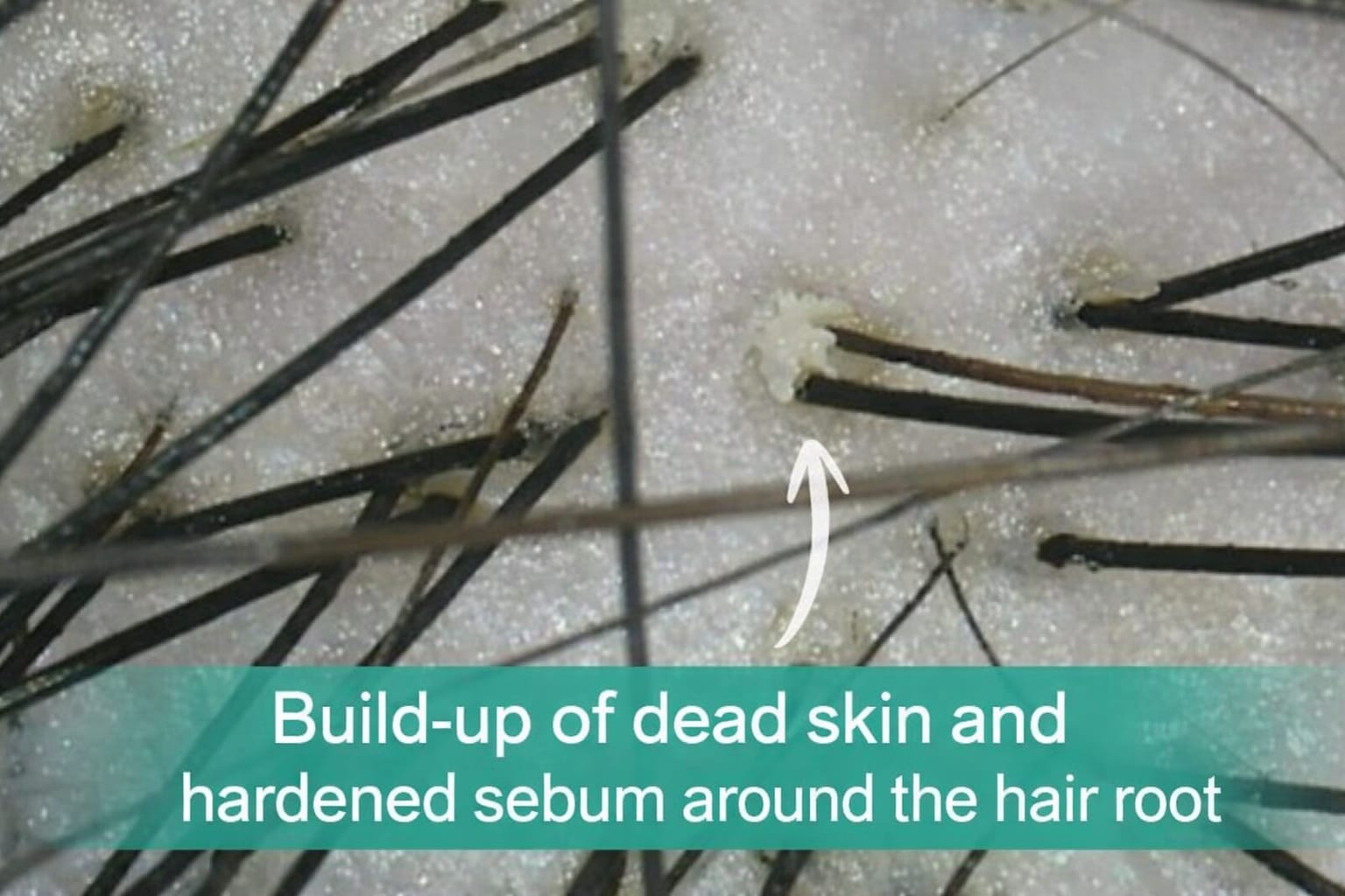 Zoey Wu 在温哥华 Salon Era 使用专业头皮检测仪近距离拍摄头皮毛囊状态，每次头皮护理前必做